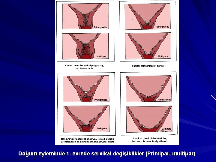 Doğum eyleminde 1. evrede servikal değişiklikler (Primipar, multipar) 