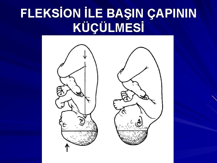 FLEKSİON İLE BAŞIN ÇAPININ KÜÇÜLMESİ 