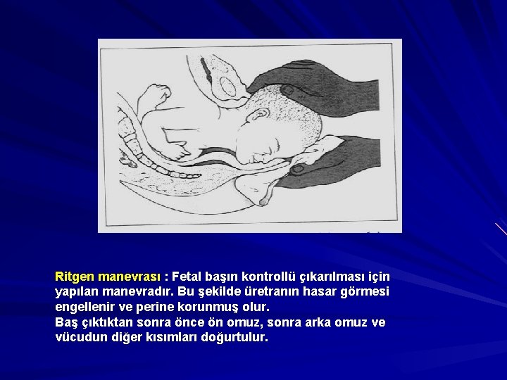 Ritgen manevrası : Fetal başın kontrollü çıkarılması için yapılan manevradır. Bu şekilde üretranın hasar