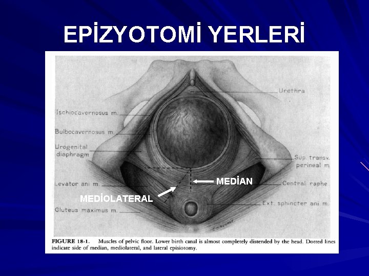 EPİZYOTOMİ YERLERİ MEDİAN MEDİOLATERAL 