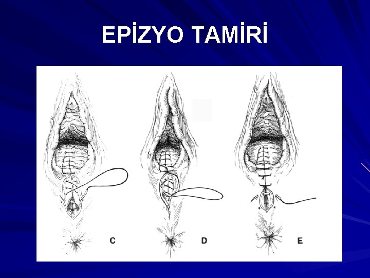 EPİZYO TAMİRİ 