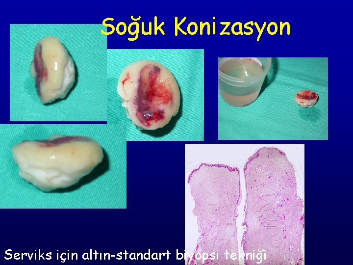 Soğuk Konizasyon Serviks için altın-standart biyopsi tekniği 