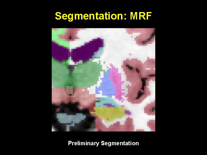 Segmentation: MRF Preliminary Segmentation 