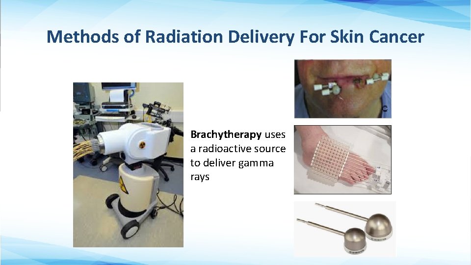 Methods of Radiation Delivery For Skin Cancer Brachytherapy uses a radioactive source to deliver