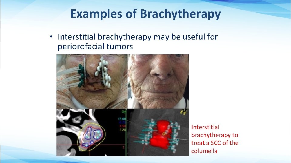 Examples of Brachytherapy • Interstitial brachytherapy may be useful for periorofacial tumors Interstitial brachytherapy