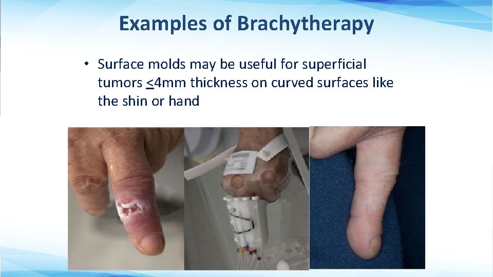 Examples of Brachytherapy • Surface molds may be useful for superficial tumors <4 mm