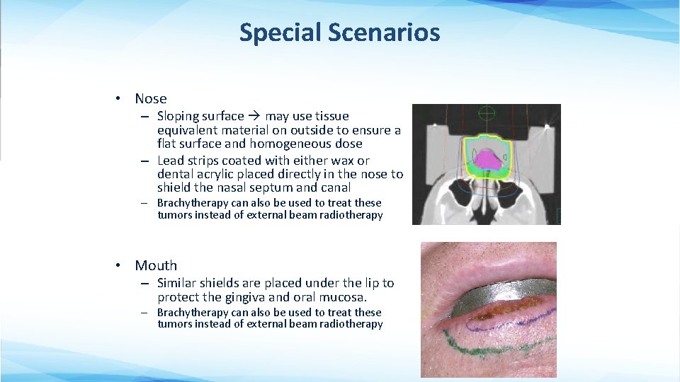 Special Scenarios • Nose – Sloping surface may use tissue equivalent material on outside