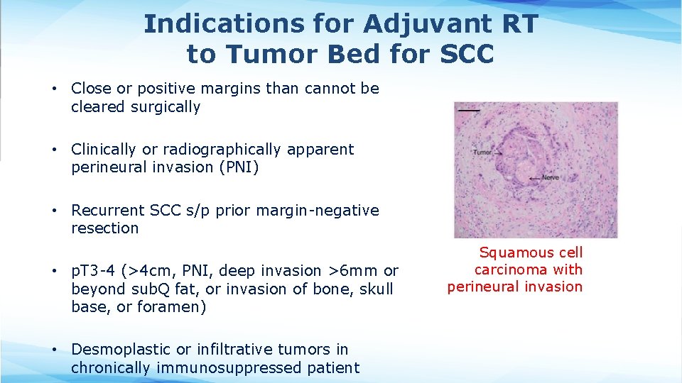 Indications for Adjuvant RT to Tumor Bed for SCC • Close or positive margins