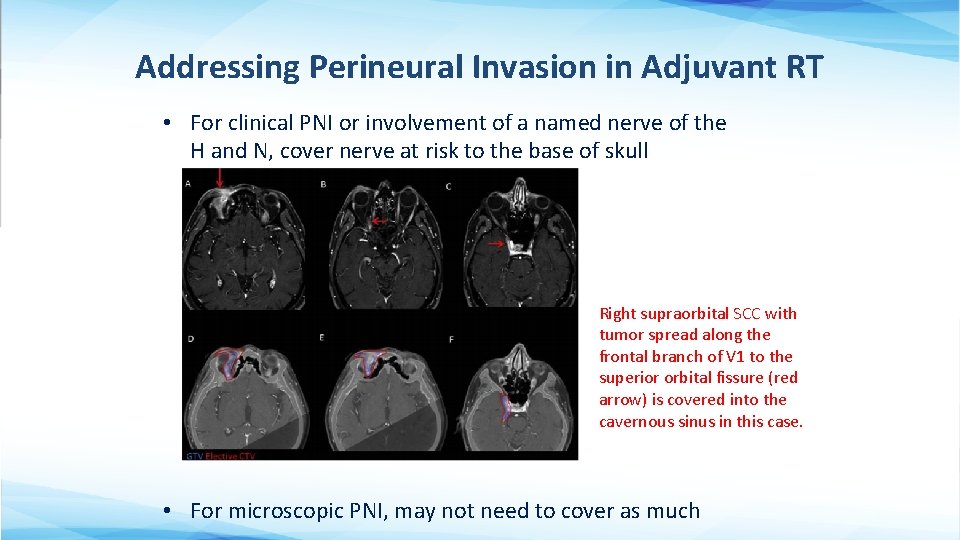 Addressing Perineural Invasion in Adjuvant RT • For clinical PNI or involvement of a