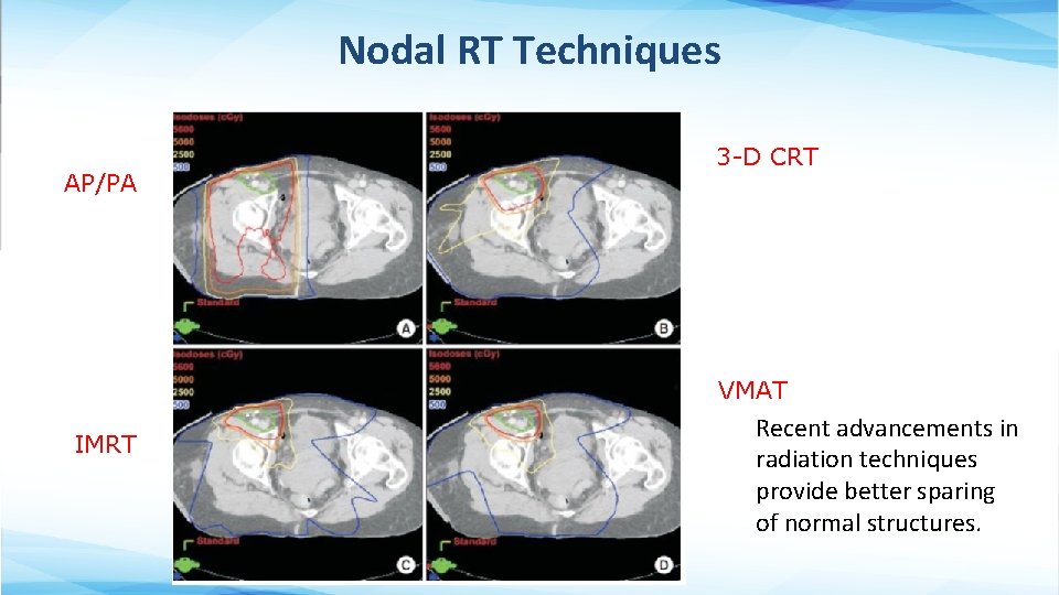 Nodal RT Techniques AP/PA 3 -D CRT VMAT IMRT Recent advancements in radiation techniques