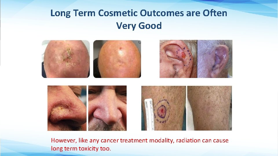 Long Term Cosmetic Outcomes are Often Very Good However, like any cancer treatment modality,