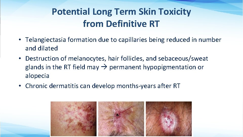 Potential Long Term Skin Toxicity from Definitive RT • Telangiectasia formation due to capillaries