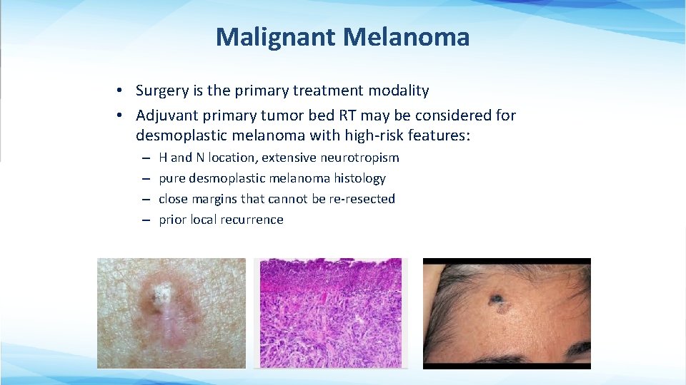 Malignant Melanoma • Surgery is the primary treatment modality • Adjuvant primary tumor bed