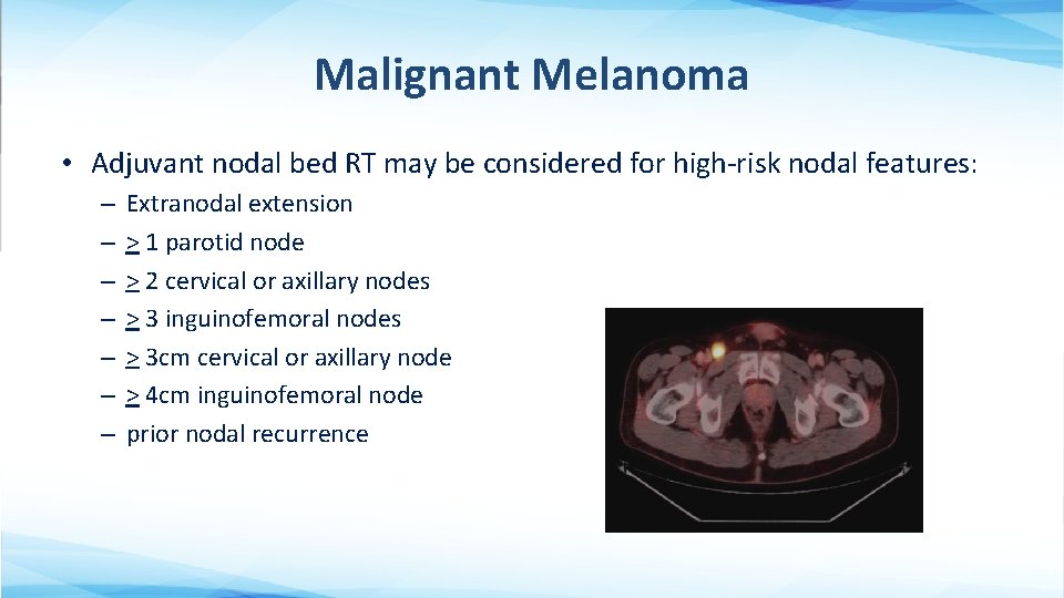Malignant Melanoma • Adjuvant nodal bed RT may be considered for high-risk nodal features: