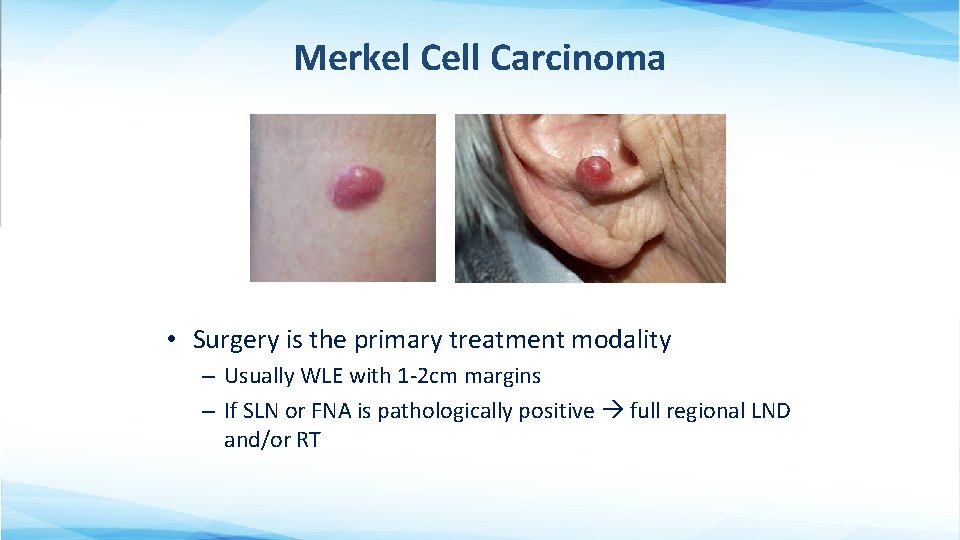 Merkel Cell Carcinoma • Surgery is the primary treatment modality – Usually WLE with