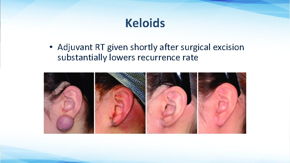 Keloids • Adjuvant RT given shortly after surgical excision substantially lowers recurrence rate 