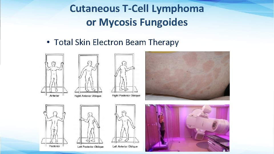 Cutaneous T-Cell Lymphoma or Mycosis Fungoides • Total Skin Electron Beam Therapy 