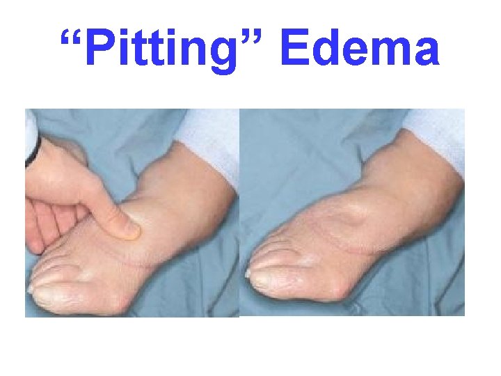 “Pitting” Edema 