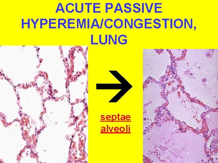 ACUTE PASSIVE HYPEREMIA/CONGESTION, LUNG septae alveoli 