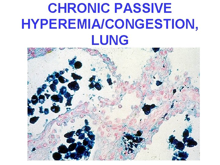 CHRONIC PASSIVE HYPEREMIA/CONGESTION, LUNG 