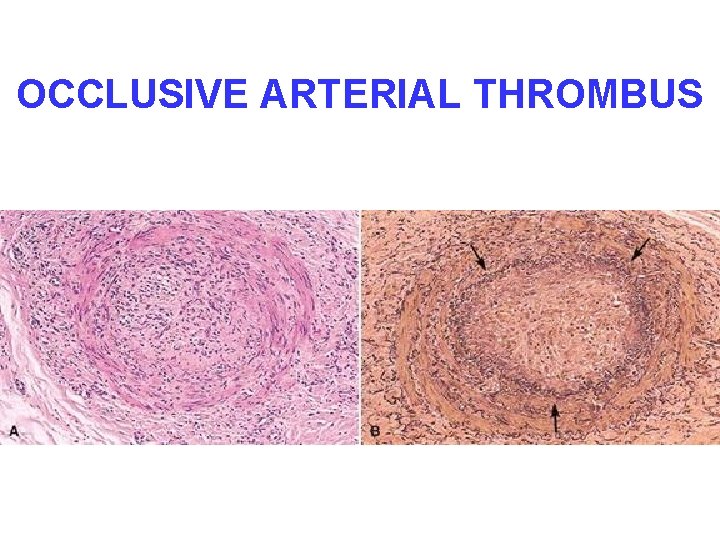 OCCLUSIVE ARTERIAL THROMBUS 