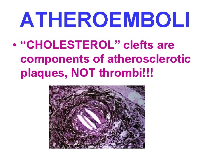 ATHEROEMBOLI • “CHOLESTEROL” clefts are components of atherosclerotic plaques, NOT thrombi!!! 