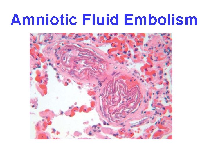 Amniotic Fluid Embolism 