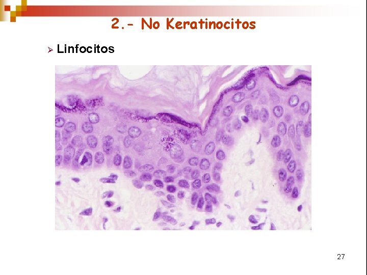 2. - No Keratinocitos Ø Linfocitos 27 