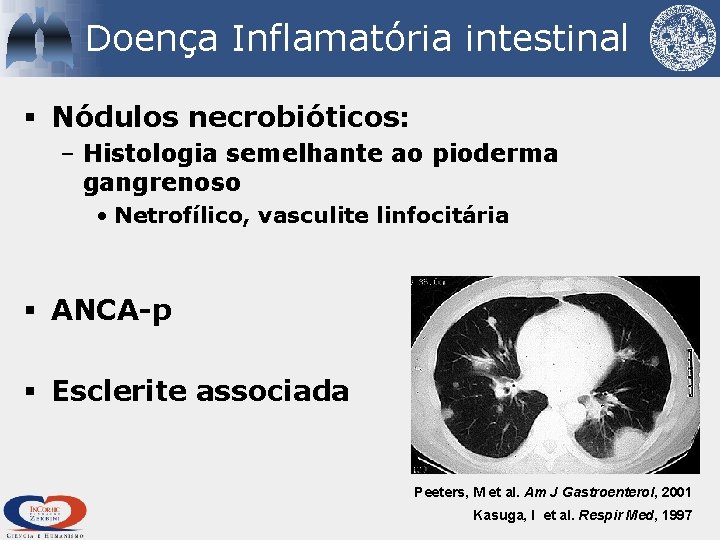 Doença Inflamatória intestinal § Nódulos necrobióticos: – Histologia semelhante ao pioderma gangrenoso • Netrofílico,