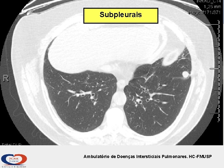 Subpleurais Ambulatório de Doenças Intersticiais Pulmonares. HC-FMUSP 