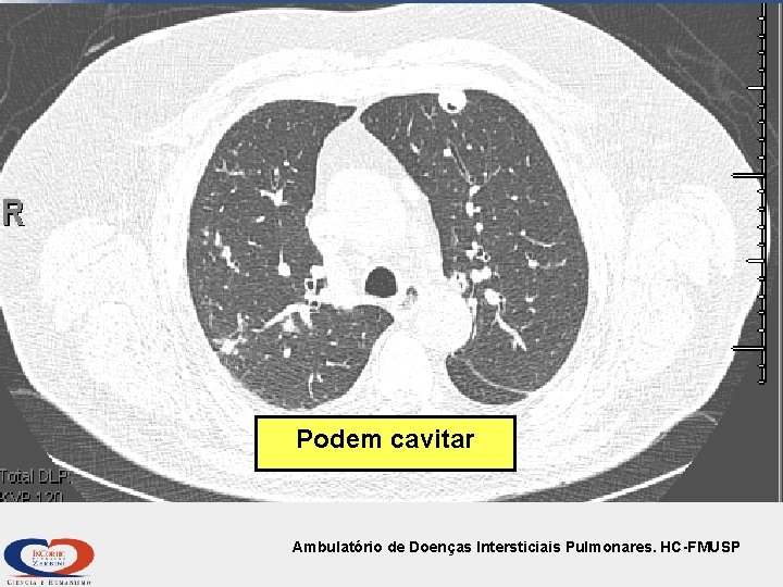 Podem cavitar Ambulatório de Doenças Intersticiais Pulmonares. HC-FMUSP 