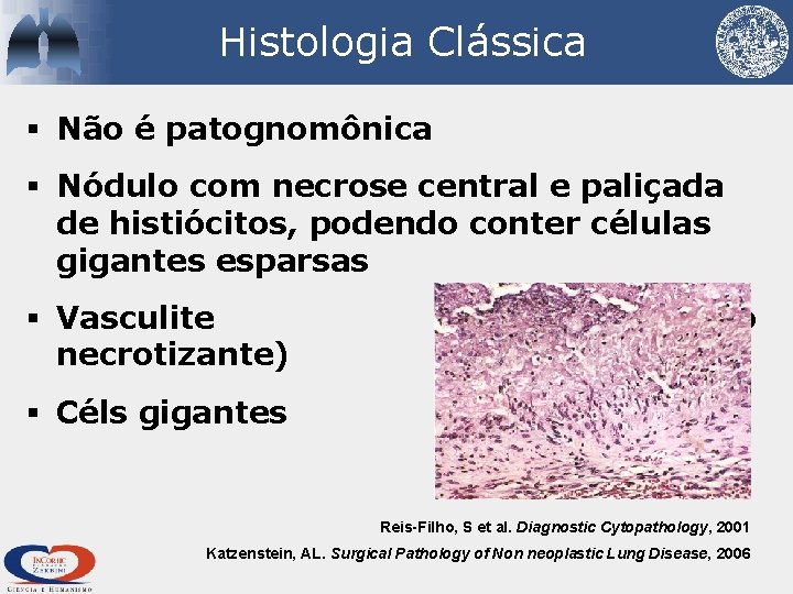 Histologia Clássica § Não é patognomônica § Nódulo com necrose central e paliçada de