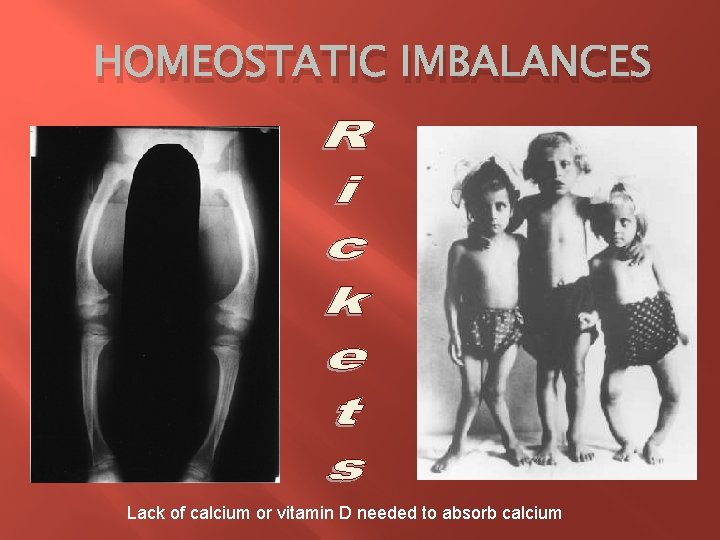 HOMEOSTATIC IMBALANCES Lack of calcium or vitamin D needed to absorb calcium 