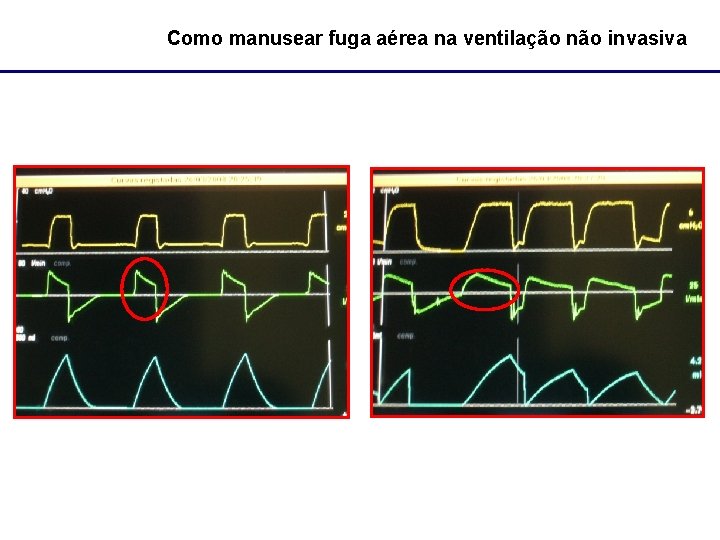 Como manusear fuga aérea na ventilação não invasiva 