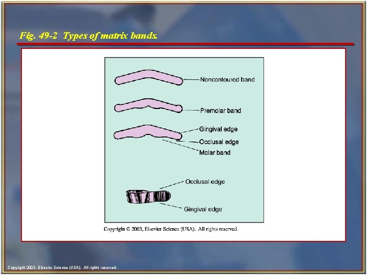 Fig. 49 -2 Types of matrix bands. Copyright 2003, Elsevier Science (USA). All rights