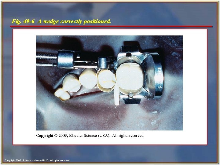 Fig. 49 -6 A wedge correctly positioned. Copyright 2003, Elsevier Science (USA). All rights