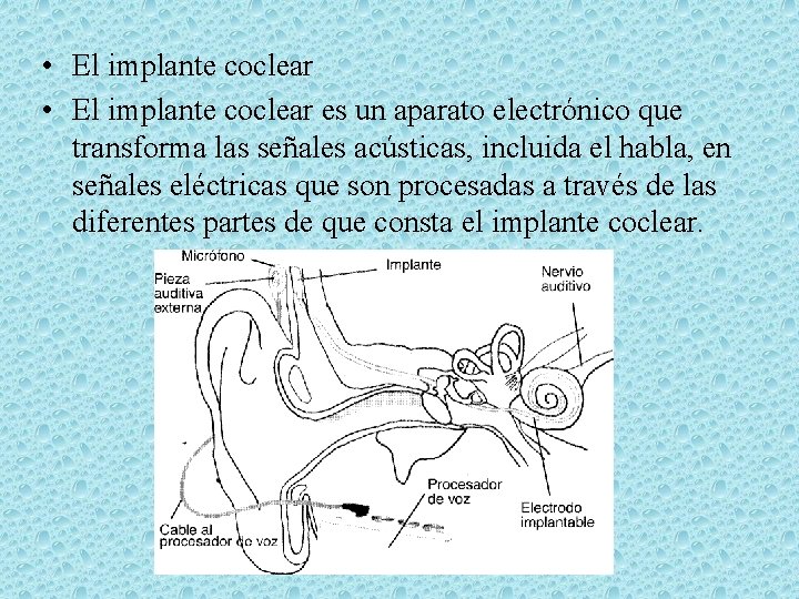  • El implante coclear es un aparato electrónico que transforma las señales acústicas,