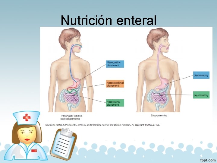 Nutrición enteral 