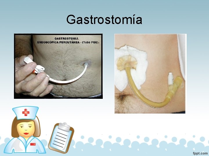 Gastrostomía 