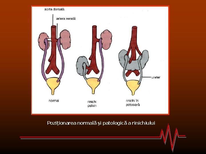 Poziţionarea normală şi patologică a rinichiului 