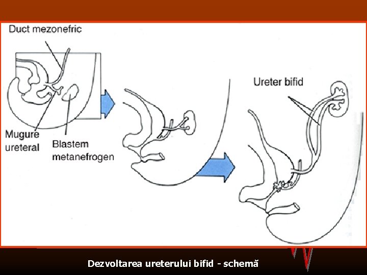 Dezvoltarea ureterului bifid - schemă 