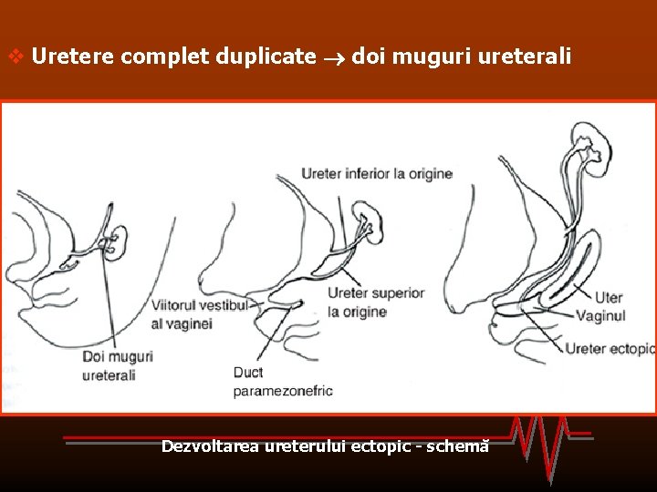 v Uretere complet duplicate doi muguri ureterali Dezvoltarea ureterului ectopic - schemă 