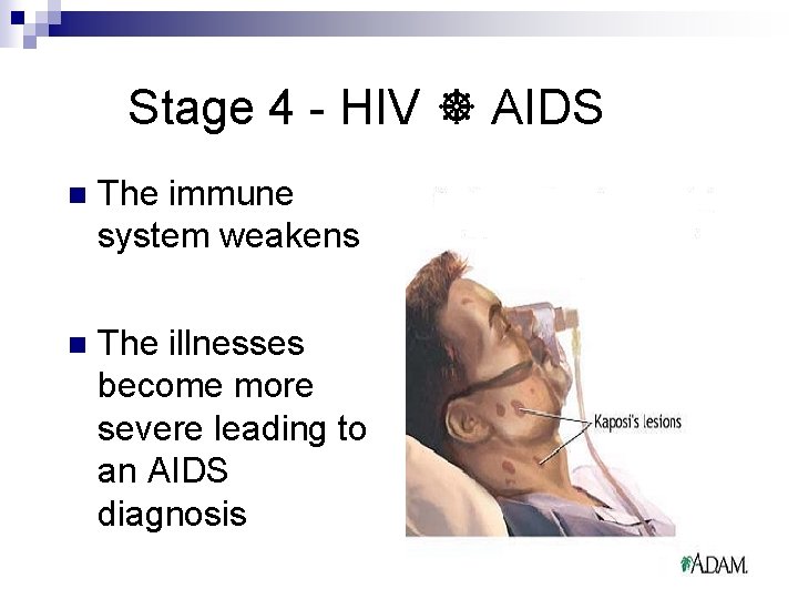 Stage 4 - HIV AIDS n The immune system weakens n The illnesses become