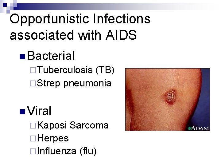 Opportunistic Infections associated with AIDS n Bacterial ¨Tuberculosis (TB) ¨Strep pneumonia n Viral ¨Kaposi