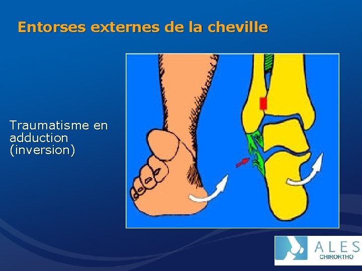 Entorses externes de la cheville Traumatisme en adduction (inversion) 