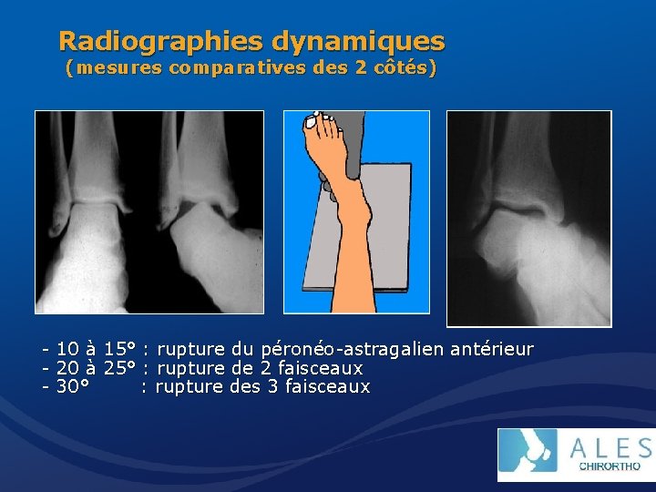 Radiographies dynamiques (mesures comparatives des 2 côtés) - 10 à 15° : rupture du