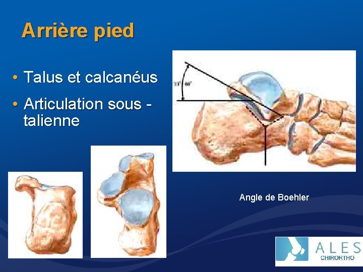 Arrière pied • Talus et calcanéus • Articulation sous talienne Angle de Boehler 