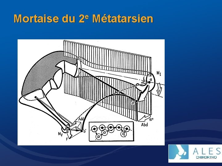 Mortaise du 2 e Métatarsien 