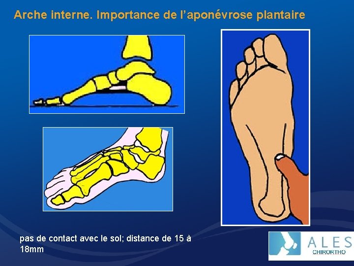 Arche interne. Importance de l’aponévrose plantaire pas de contact avec le sol; distance de