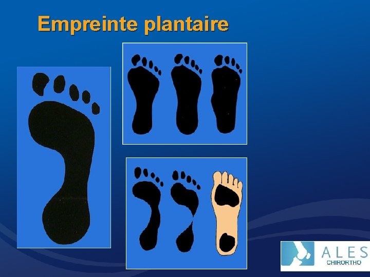 Empreinte plantaire 